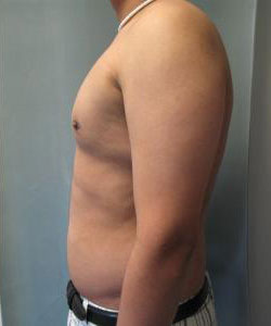 Severe Gynecomastia