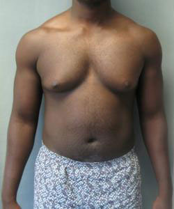 Severe Gynecomastia