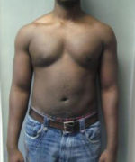 Severe Gynecomastia