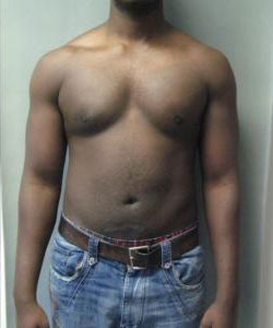 Severe Gynecomastia After Photo Severe Gynecomastia