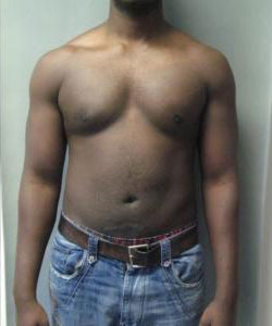 Severe Gynecomastia