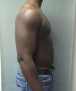 Severe Gynecomastia