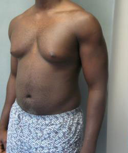 Severe Gynecomastia