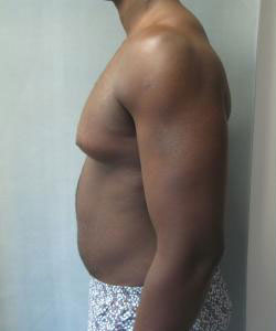 Severe Gynecomastia