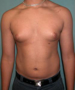Severe Gynecomastia Before Photo Severe Gynecomastia