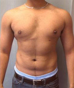 Severe Gynecomastia After Photo Severe Gynecomastia