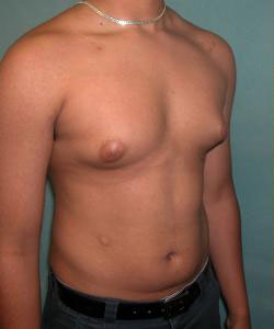 Severe Gynecomastia