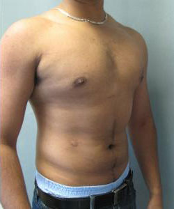 Severe Gynecomastia