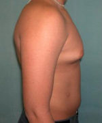 Severe Gynecomastia