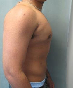 Severe Gynecomastia