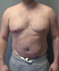 Severe Gynecomastia Before Photo Severe Gynecomastia