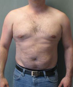Severe Gynecomastia After Photo Severe Gynecomastia
