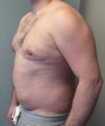 Severe Gynecomastia