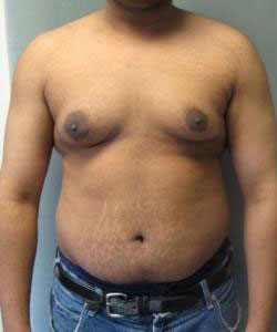 Severe Gynecomastia