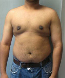Severe Gynecomastia After Photo Severe Gynecomastia