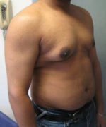 Severe Gynecomastia