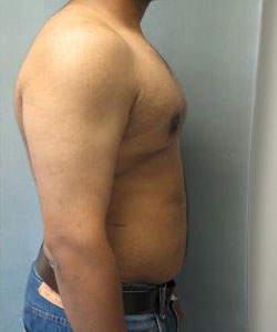 Severe Gynecomastia