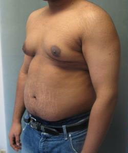 Severe Gynecomastia