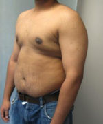 Severe Gynecomastia