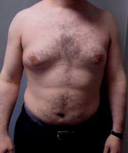 Severe Gynecomastia Before Photo Severe Gynecomastia