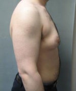 Severe Gynecomastia