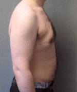 Severe Gynecomastia