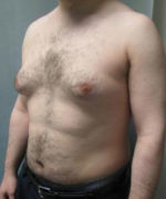 Severe Gynecomastia