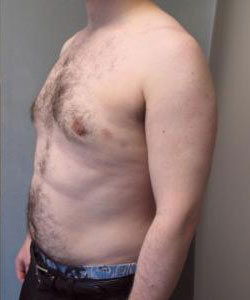 Severe Gynecomastia