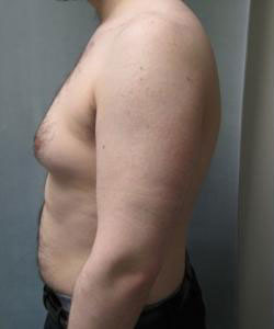 Severe Gynecomastia