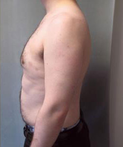 Severe Gynecomastia