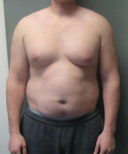 Severe Gynecomastia Before Photo Severe Gynecomastia