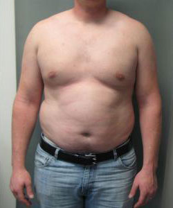 Severe Gynecomastia