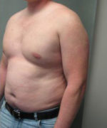 Severe Gynecomastia