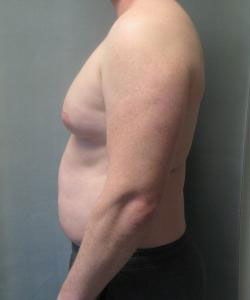 Severe Gynecomastia