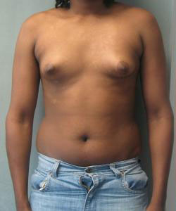 Severe Gynecomastia