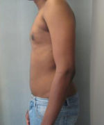 Severe Gynecomastia