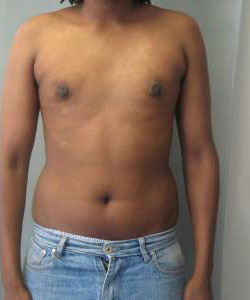 Severe Gynecomastia