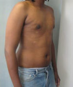 Severe Gynecomastia