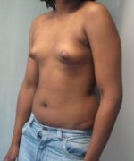 Severe Gynecomastia