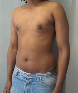 Severe Gynecomastia