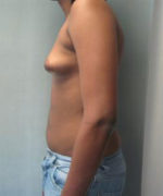 Severe Gynecomastia