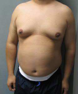 Severe Gynecomastia Before Photo Severe Gynecomastia
