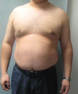 Severe Gynecomastia After Photo Severe Gynecomastia