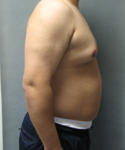 Severe Gynecomastia