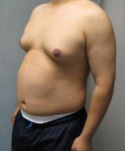 Severe Gynecomastia