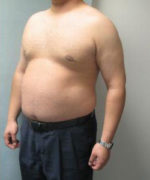 Severe Gynecomastia