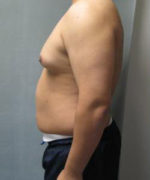 Severe Gynecomastia