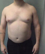 Severe Gynecomastia