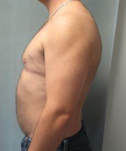 Severe Gynecomastia