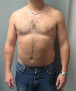 Severe Gynecomastia